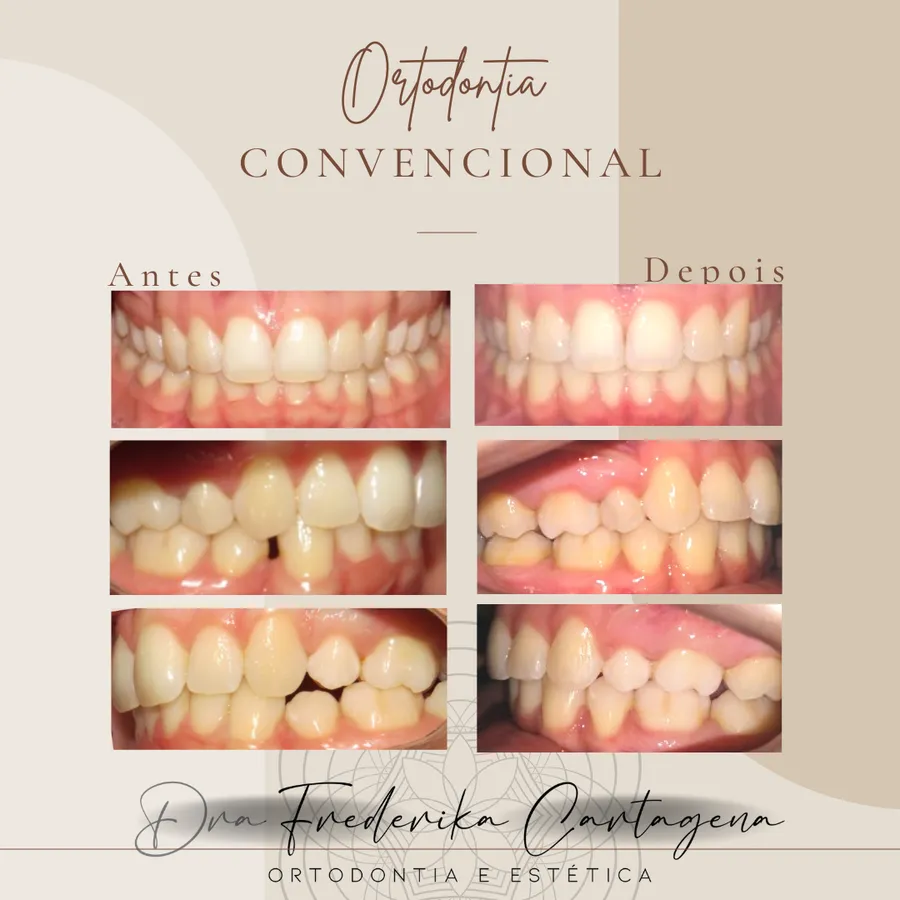 Antes e depois — Ortodontia convencional