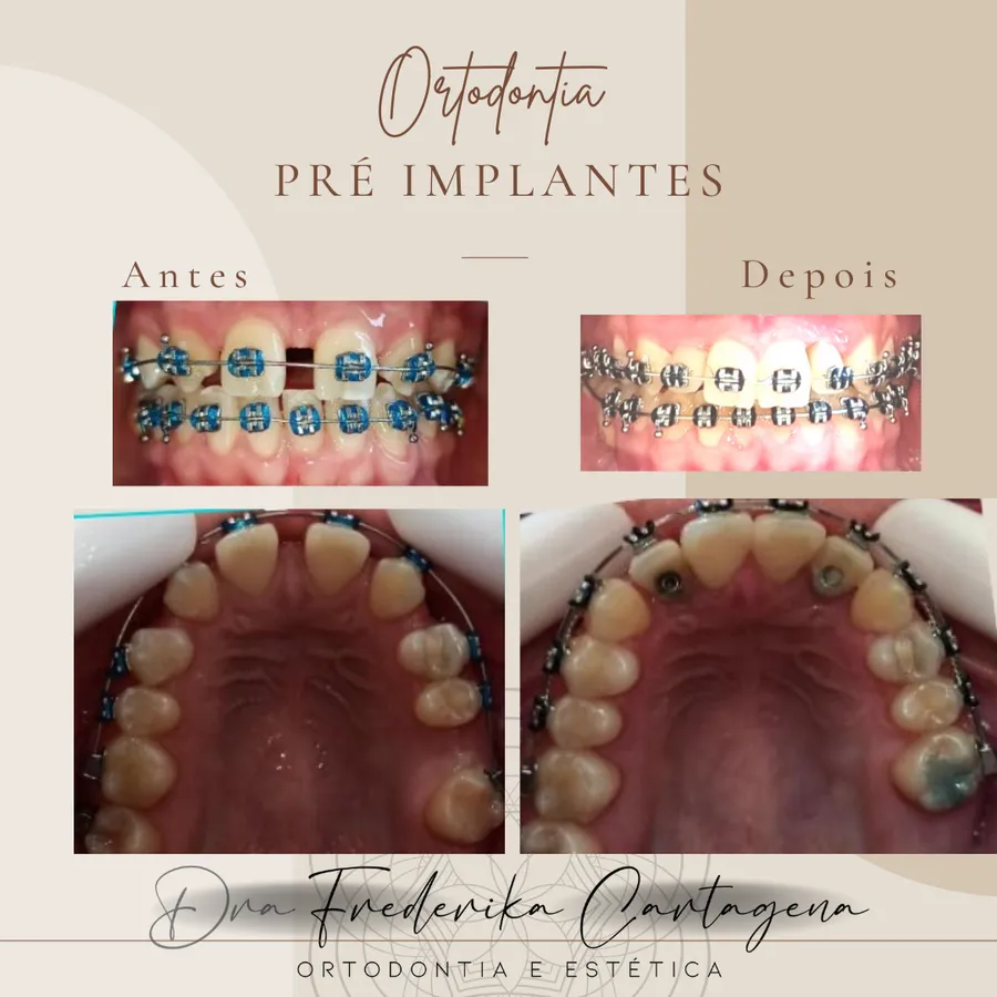 Antes e depois — Ortodontia pré-implantes