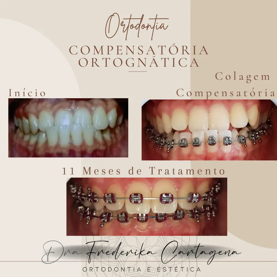 Início e 11 meses de tratamento — Ortodontia compensatória ortognática